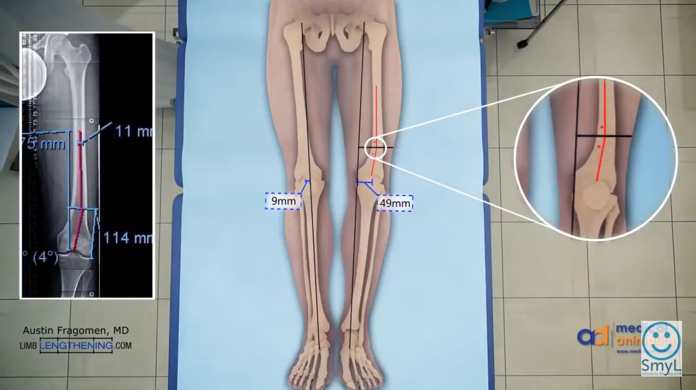 Betzbone limb lengthening